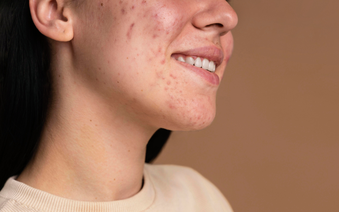 acne_1080x675
